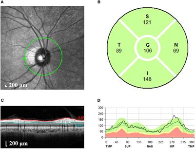 Optical coherence tomography of the retina combined with color Doppler ultrasound of the tibial nerve in the diagnosis of diabetic peripheral neuropathy